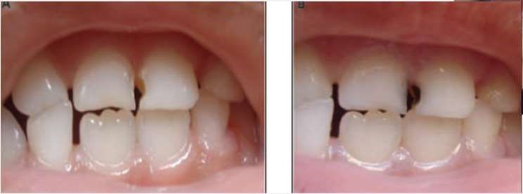 Silver Diamine Fluoride Teeth