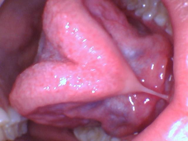 tongue-tie